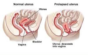 Pelvic Organ Prolapse