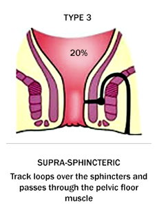 Fistula type 3