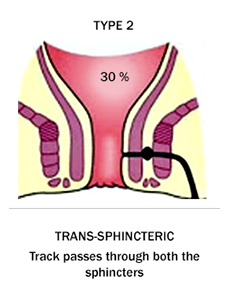 Fistula type 2