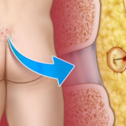 Pilonidal sinus treatment  Laser surgery for pionidal sinus