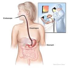 Endoscopy Procedure