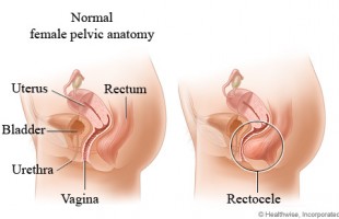 rectocele image