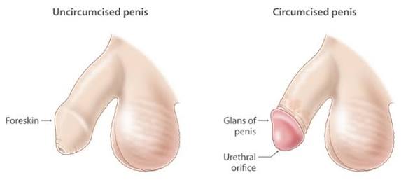 Penis uncut cut Circumcised or