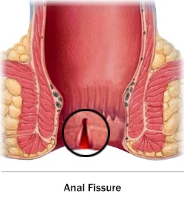 Anal fissure from anal sex