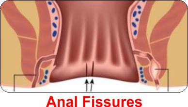 anal fissure treatment