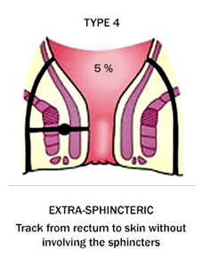 Extra Sphincteric