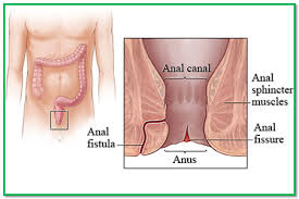 Fistula Treatment