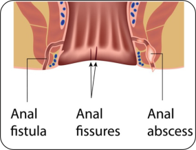 Fistula doctor