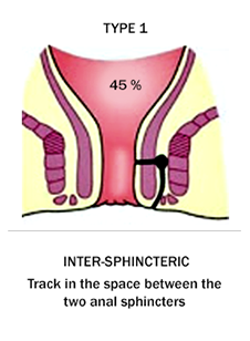 Inter Sphincteric