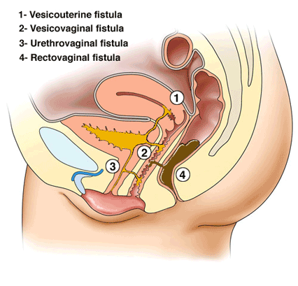 Obstetric Fistula Treatment