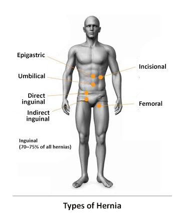 Types of hernia