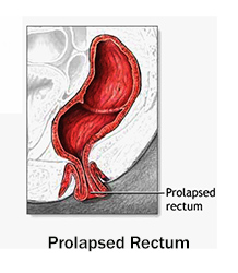 Rectal Prolapse