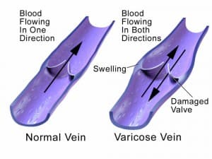 what is variocse veins? causes and treatment of varicose veins